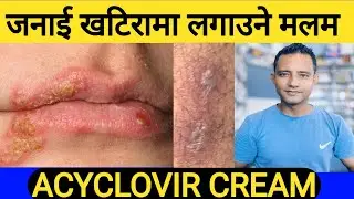 जनाई खटिरा र माकुराले छुंदा आउने खटिरामा लगाउने मलम ।ACYCLOVIR cream uses in Nepali!#health