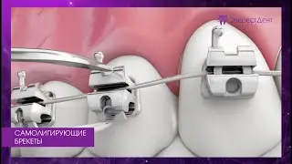 Самолигирующие брекеты.