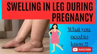Common Reasons for Swelling in leg during Pregnancy