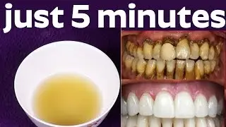 How to turn Yellow Teeth to White Teeth | How to whiten your teeth naturally at Home | Health Tips