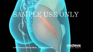 Total hip replacement