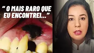 Oral mucosal melanoma/ How to recognize and treat this oral cancer