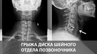 Грыжа диска шейного отдела позвоночника - симптомы и лечение