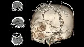 Surgical treatment of anterior skull base meningioma irradiated with gamma knife