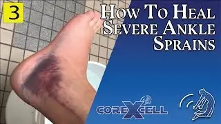 Severe Ankle Sprain - Healed RAPIDLY with Two Techniques - Ep3