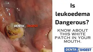 leukoedema: Is this white patch in the mouth Dangerous?