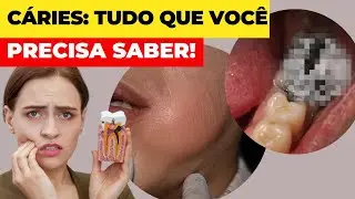 Cáries Dentárias:  O Que Realmente São e Como Elas Se Desenvolvem