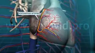 сердце коронарная артерия раскупорка