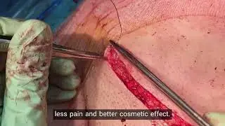 COR 433 092024 Skin incision closure after csection