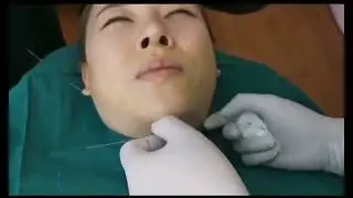 Non-Surgical Double Chin Lifting with Double Needle PDO- Lift thread