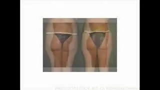 Buttock Lift | Gluteoplasty | Berkeley Plastic Surgeon