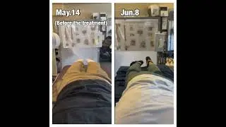 ALS treatment result after 3 weeks