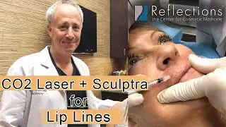 Sculptra + CO2 for Lip Lines [New Treatment]