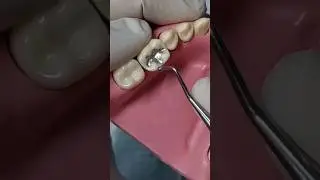 حشو امالجم كلاس ١ / Application of amalgam restoration