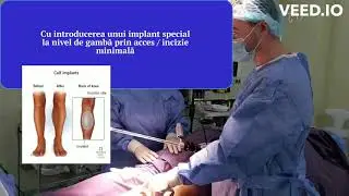 Marirea de gambe prin implant. O formă și o definiție dezirabile a picioarelor