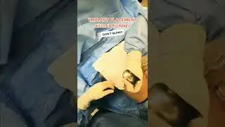 Breast Implant Placement Procedure