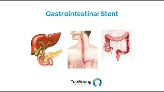 TaeWoong Medical - Niti S™ Gastrointestinal Stent final
