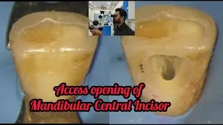 Access opening of Mandibular Central Incisor step by step demonstration# rct for beginners #rct