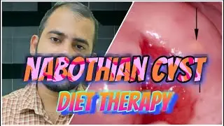 Nabothian Cyst Diet|Women’s Health|Controlling Ovarian Cyst