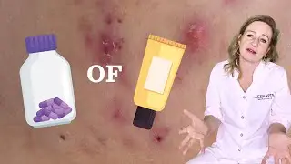 Acne behandelingen uitgelegd