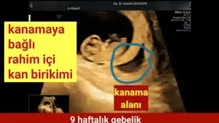 9 haftalık gebelik subkoryonik hematom (kanama alanı) ultrason görünümü, bebek sağlıklı ve hareketli