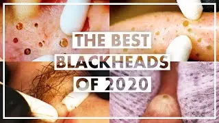 The Best Blackheads of 2020 Compilation + Q&A (Lip, Ear, Nose and Back Blackheads)