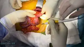 Senkron Kalın Bağırsak Kanseri Ameliyatı, Kansız Teknik | Prof. Dr. Ünal Aydın