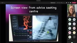 Neurovascular Intervention Patient-Specific Simulated Case using ANGIO Mentor Simulator