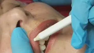 ГУБЫ ,,чайка,,. Коррекция ТОКСИНОМ.
