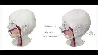Glossoptosis (Tongue Fall back into Throat) ; Causes, Symptoms, Diagnosis, Treatment