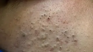 [ASMR] Blackheads Removal and Whitehead Removal for Deep Pore Cleansing