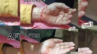 Injecting local anaesthesia for a laceration । ମା ଙ୍କ ଲୋକାଲ ସର୍ଜରୀ ଆରମ୍ଭ । 