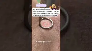 Когда мне говорят , что невозможно помочь, я показываю работу лазера 🔥 #недержание  #краурозвульвы