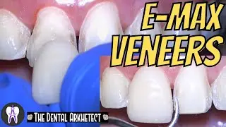 EMAX Porcelain Veneer! HOW Do they DO it? 