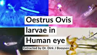 Parasitic infection of human eye by Botfly Larvae (Oestrus Ovis)!!!
