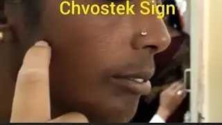 Chvostek Sign - Hypocalcemia