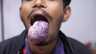 Worlds Largest Tongue Hemangioma