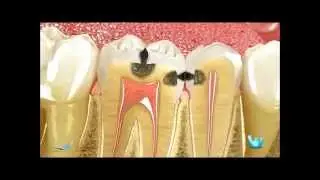 ¿QUÉ ES UNA ENDODONCIA?