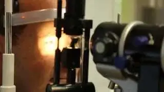SMILE Laser Eye Surgery