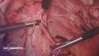 Peritoneal Skinning Technique for Endometriosis | Safe Laparoscopy