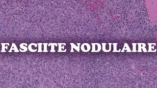 LA FASCIITE NODULAIRE – PATHOLOGIE