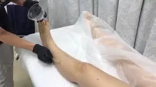 Лазерная эпиляция диодным лазером Capello(Italia)
