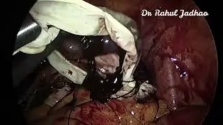 Left tubal ectopic pregnancy
