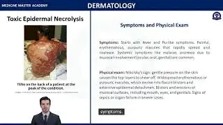 Toxic Epidermal Necrolysis - USMLE and IFOM