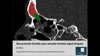 Sinosotomie frontale pour sinusite bloquée par voie endonasale