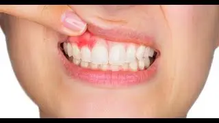 علاج منزلي سريع لالتهاب اللثة