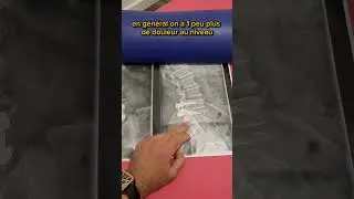 arthrodese lombaire à regarder pour comprendre