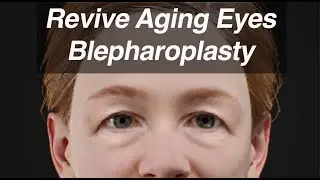 Blepharoplasty (Eyelid Surgery) to Revive Aging Eyes and Look Years Younger