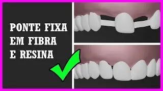 PRÓTESE DENTÁRIA DE UM DENTE SÓ - Técnica adesiva