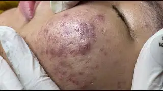 Inflamatory acne causes painful ( VA P.1) #HoangMySpa101